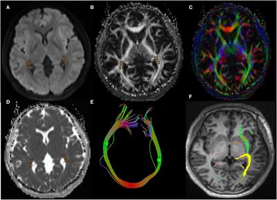 Thyroid-associated ophthalmopathy: Using diffusion tensor imaging to evaluate visual pathway microstructural changes